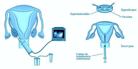 La transferencia embrionaria